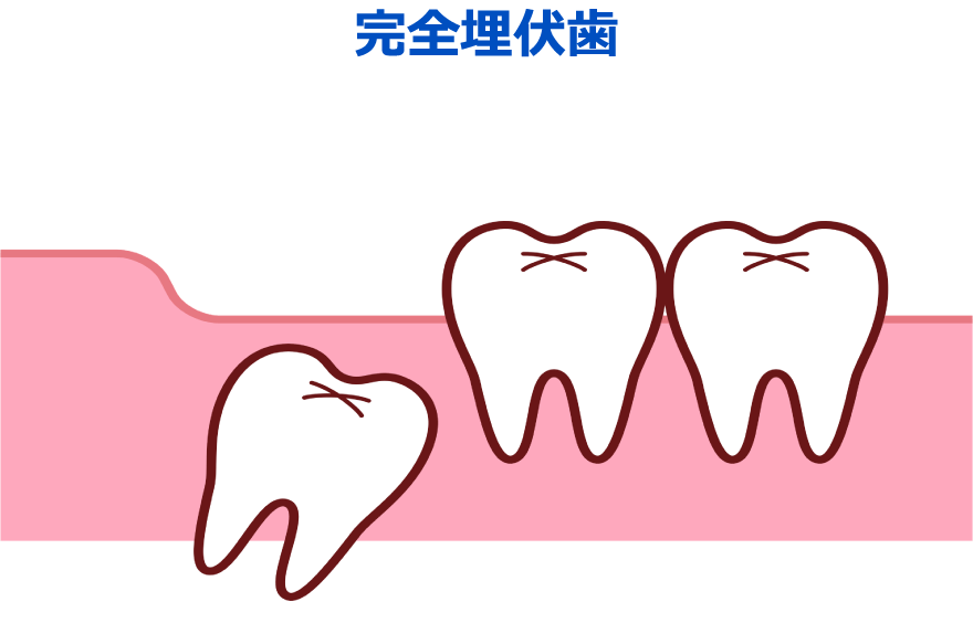 完全埋伏歯