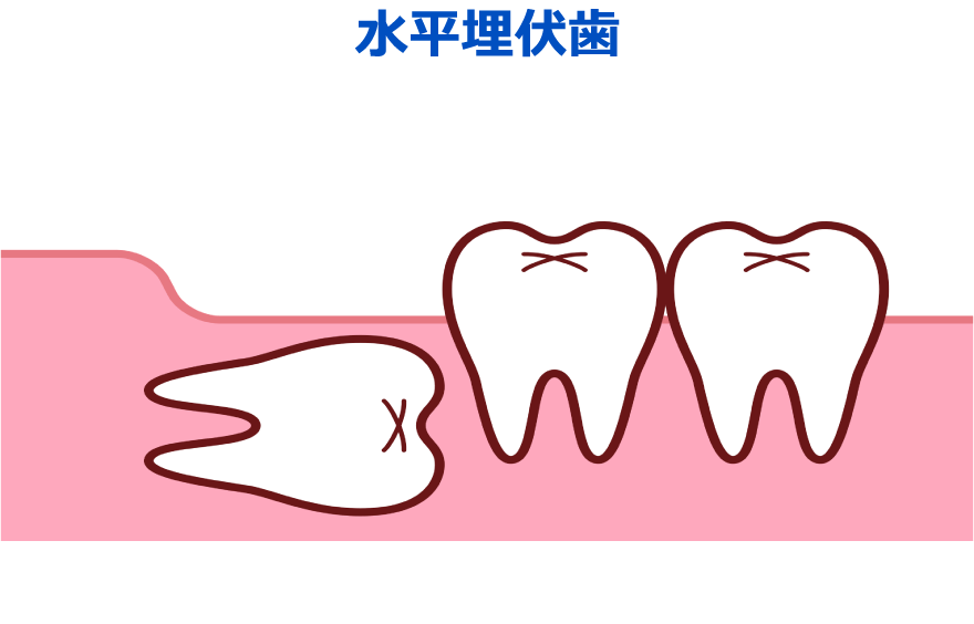 水平埋伏歯