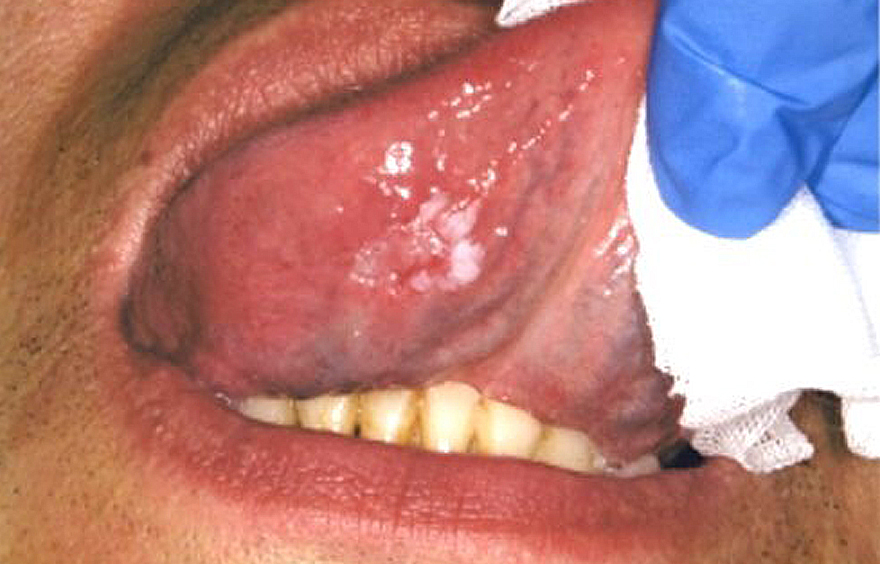 早期舌癌
