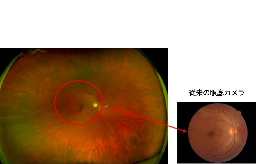 広角眼底カメラによる眼底写真