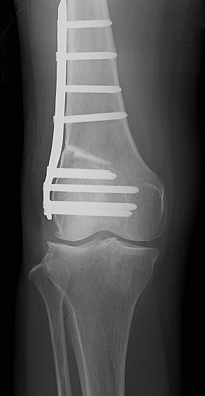 遠位大腿骨骨切り術（DFO)