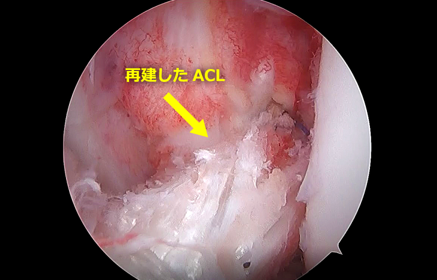 前十字靭帯（ACL）再建術後